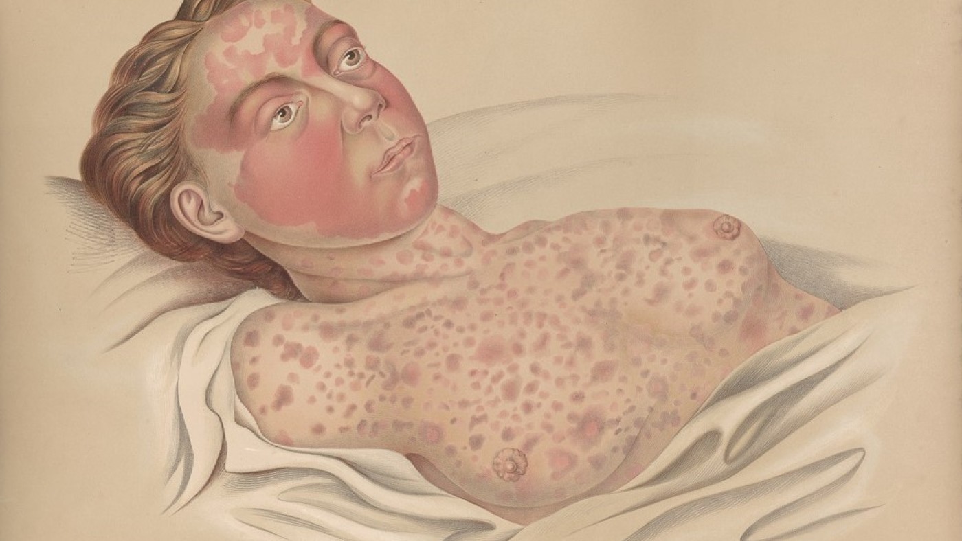 A person infected with colera (Atlas der Hautkrankheiten
von Ferdinand von Hebra, 1856) | © Narrenturm A person infected with colera (Atlas der Hautkrankheiten von Ferdinand
von Hebra, 1856) | © Narrenturm