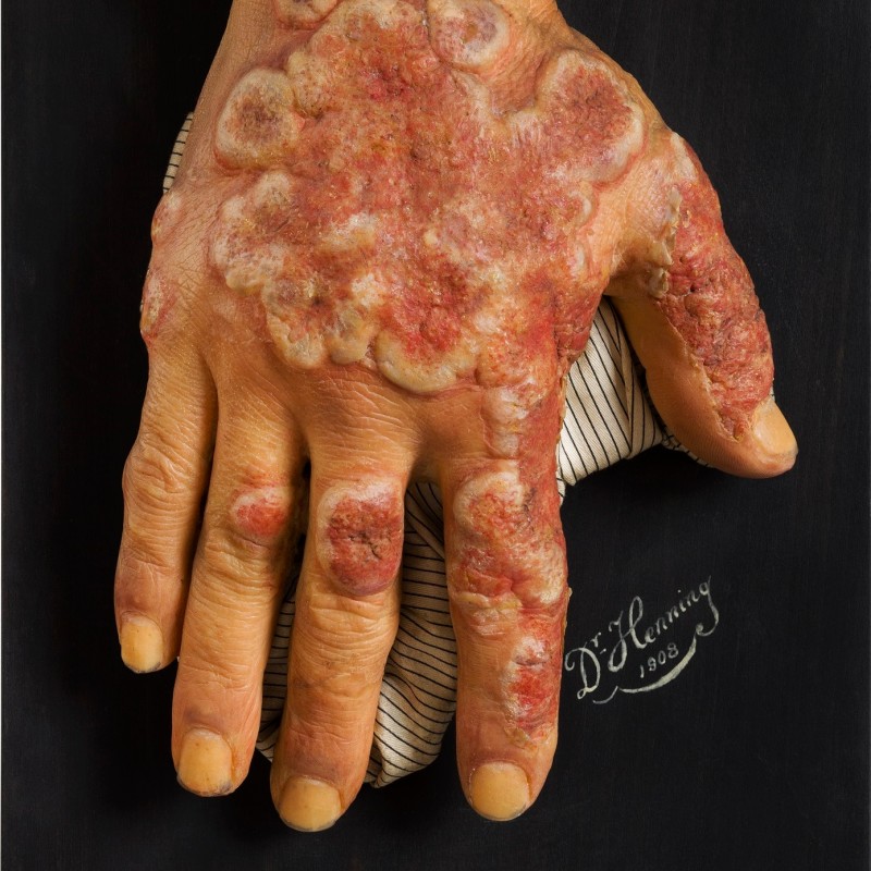 Rötungen und Entzündungen der Haut, Erythema multiforme
                                 exsudativum (c) NHM Wien, Reiner Riedler
