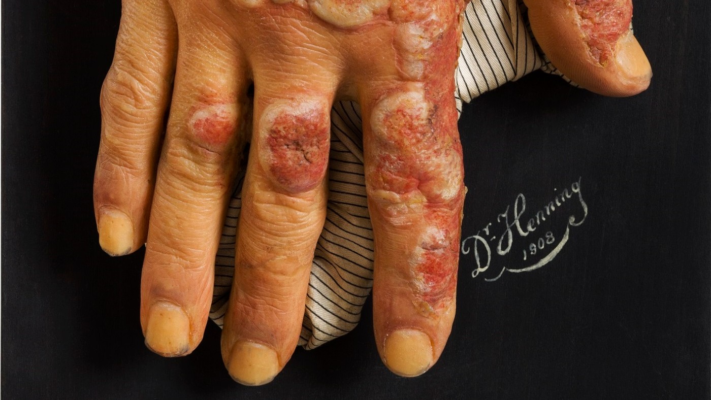 Redness and inflammation of the skin, Erythema multiforme exsudativum (c) NHM Wien, Reiner Riedler